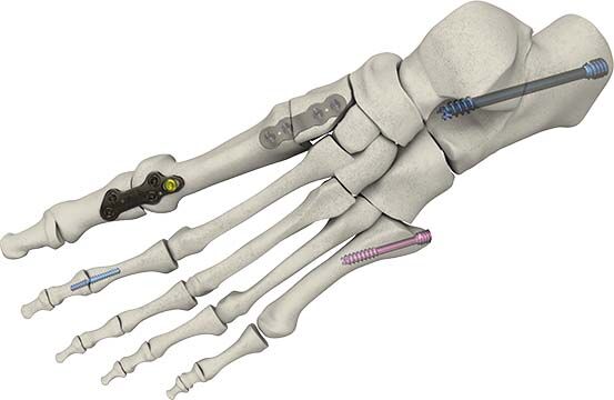 axomed - Innovative Platten für Frakturen, Osteotomien und Arthrodesen