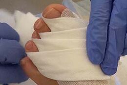 Zuerst wird ein ca. 10 cm langes Stück Tape längs v-förmig eingerissen. Die Basis des V wird am Fußrücken festgeklebt, die beiden 1 cm breiten Schenkel werden zur Fußsohle geführt.